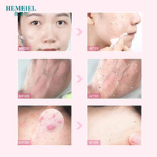 Load image into Gallery viewer, HEMEIEL Deep Clean Hyaluronic Acid Exfoliating Peeling Gel Smoothen Facial Scrub Gel Polish Acne Blackhead Remove Face Cleanser